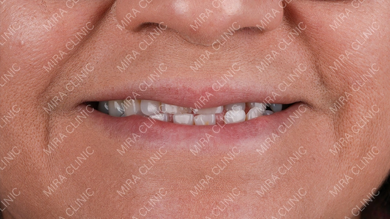  tooth spacing patient experience